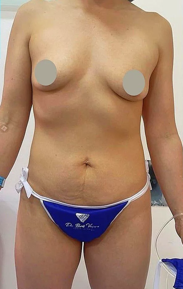 Mamoplastia + Lipoescultura — Antes