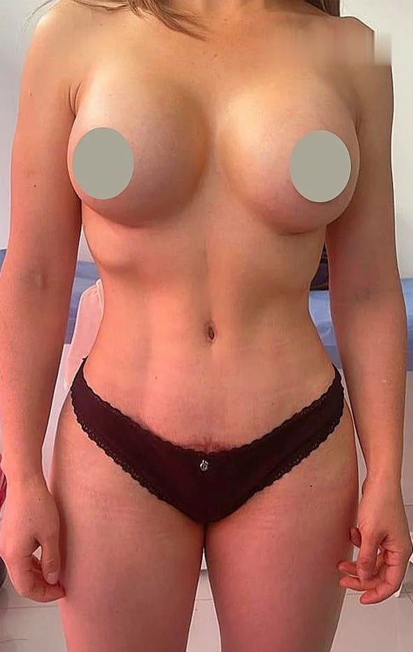 Mamoplastia + Lipoescultura — Después