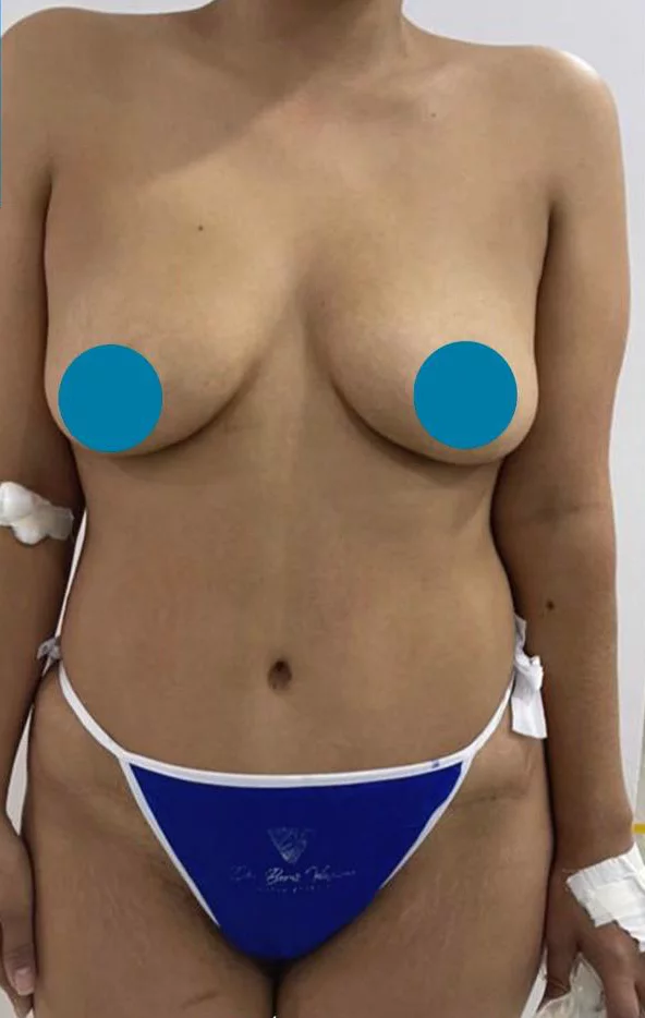 Mamoplastia + contorno corporal — Antes