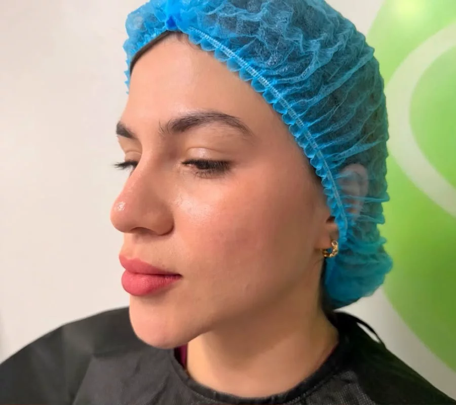 Rinoplastia — tres cuartos — Antes