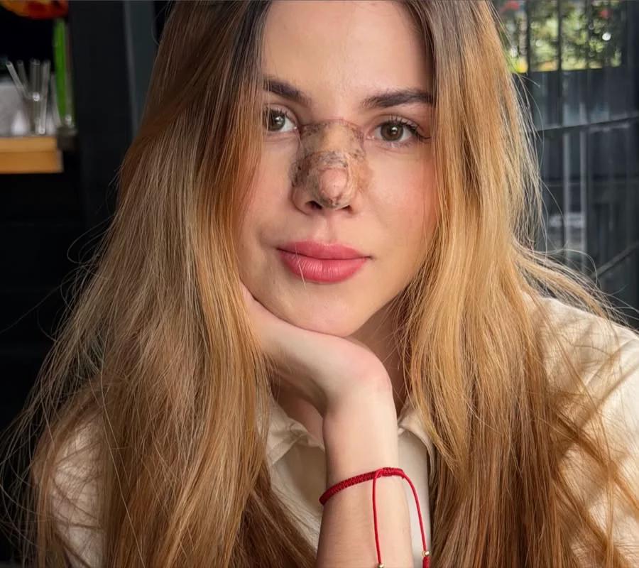 Rinoplastia — tres cuartos — Después