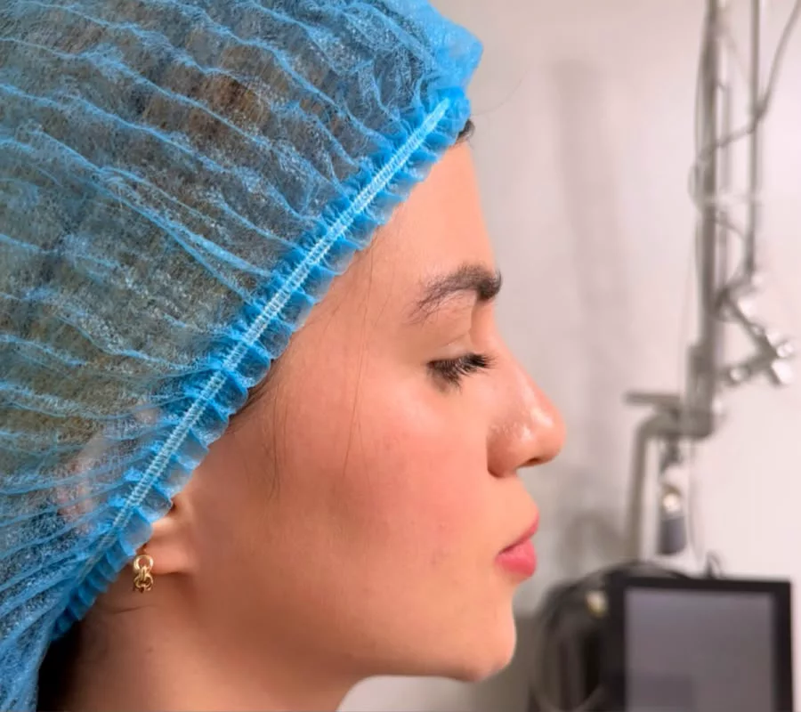Rinoplastia — perfil — Antes