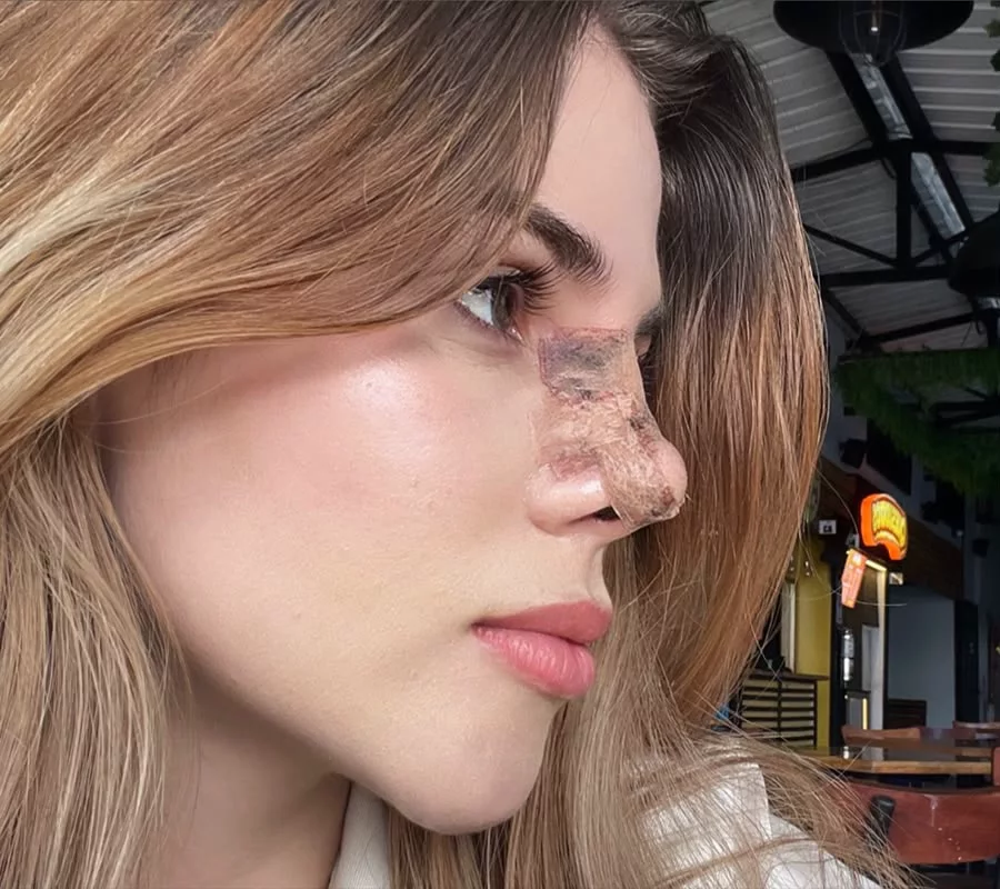 Rinoplastia — perfil — Después
